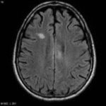 What is a Diffuse Axonal Injury? (DAI)